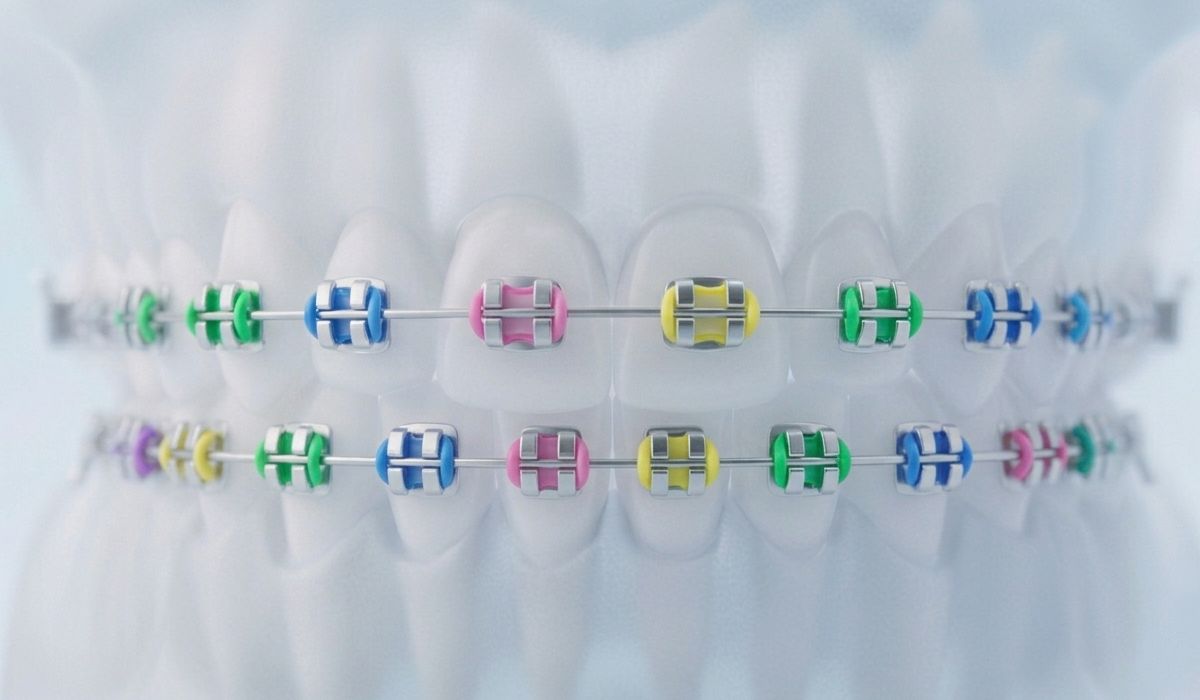 Brackets metalicos tradicionales con gomas de ortodoncia sobre un modelo dental.